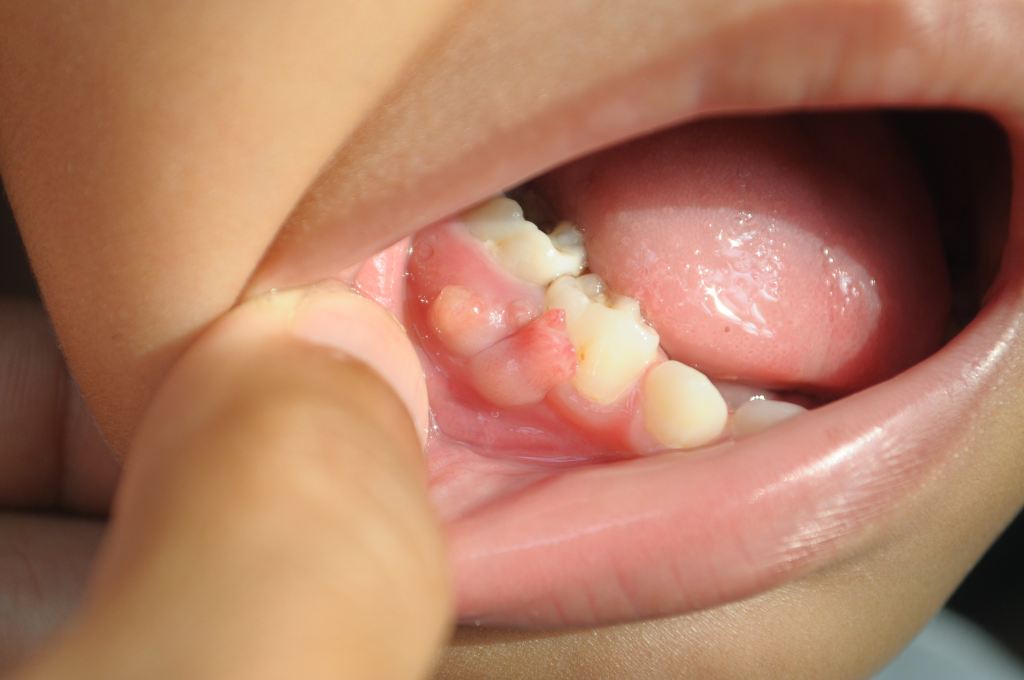 Simple Ways to Care for Gums for Heart Health VUONS